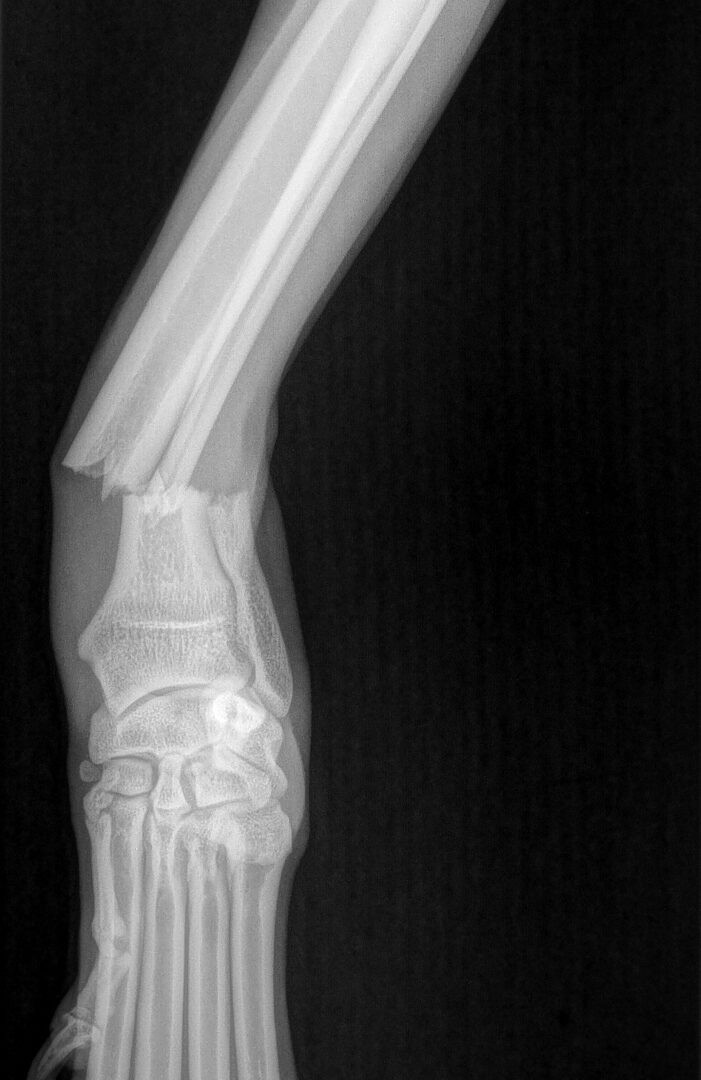 Röntgenbild des linken Unterarms und der linken Hand mit sichtbarem Bruch der Speiche und der Elle in der Nähe des Handgelenks, die Knochen sind falsch ausgerichtet.