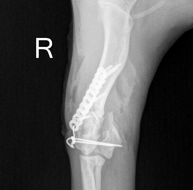 Röntgenbild des rechten Beins mit Metallplatte und Schrauben am gebrochenen Knochen. "R" steht für die rechte Seite und die chirurgische Reparatur.
